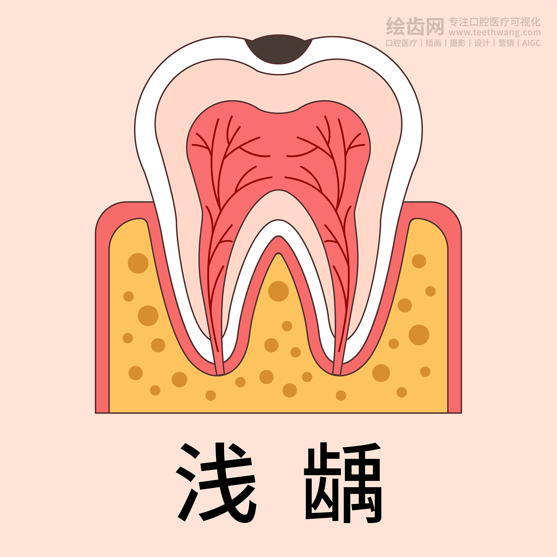 牙齿插画 龋坏过程 龋齿类型（黄色背景）