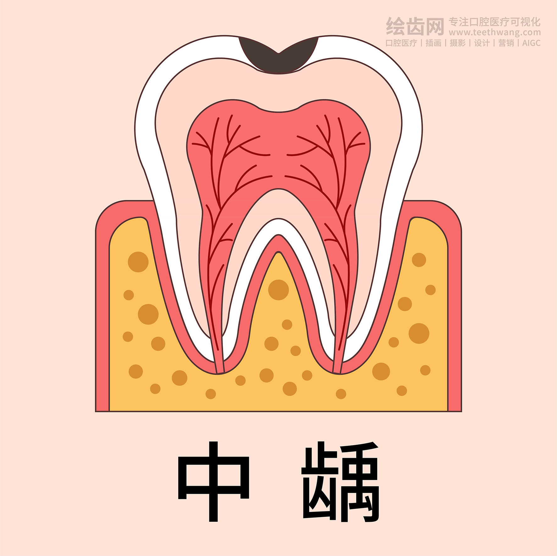 牙齿插画 龋坏过程 龋齿类型（黄色背景）