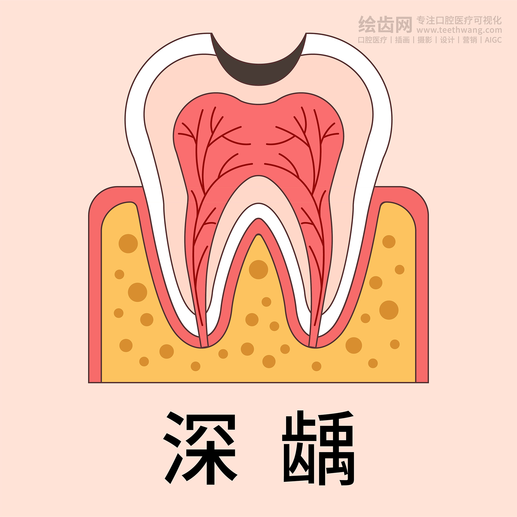 牙齿插画 龋坏过程 龋齿类型（黄色背景）