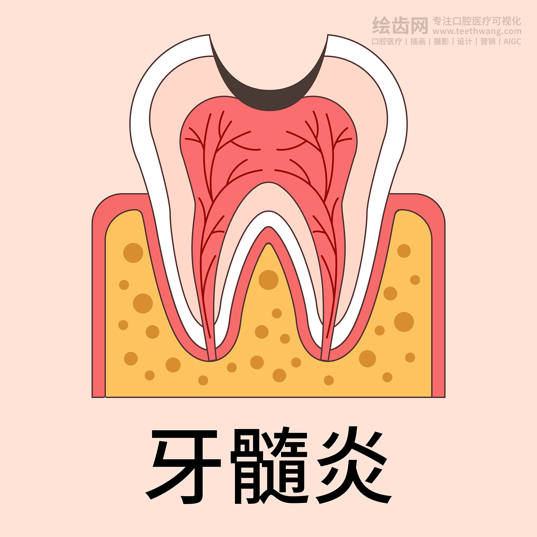 牙齿插画 龋坏过程 龋齿类型（黄色背景）