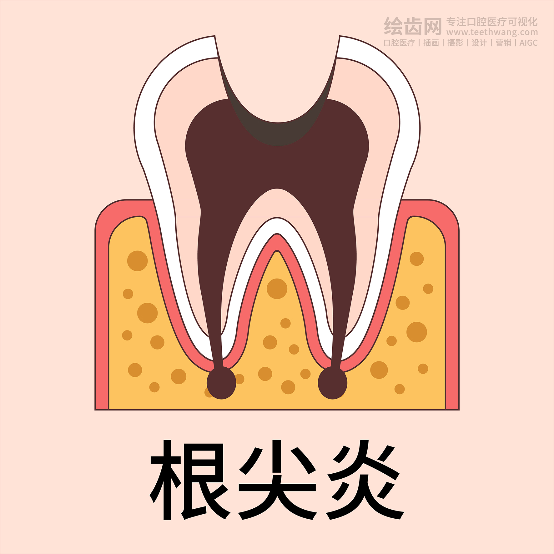 牙齿插画 龋坏过程 龋齿类型（黄色背景）