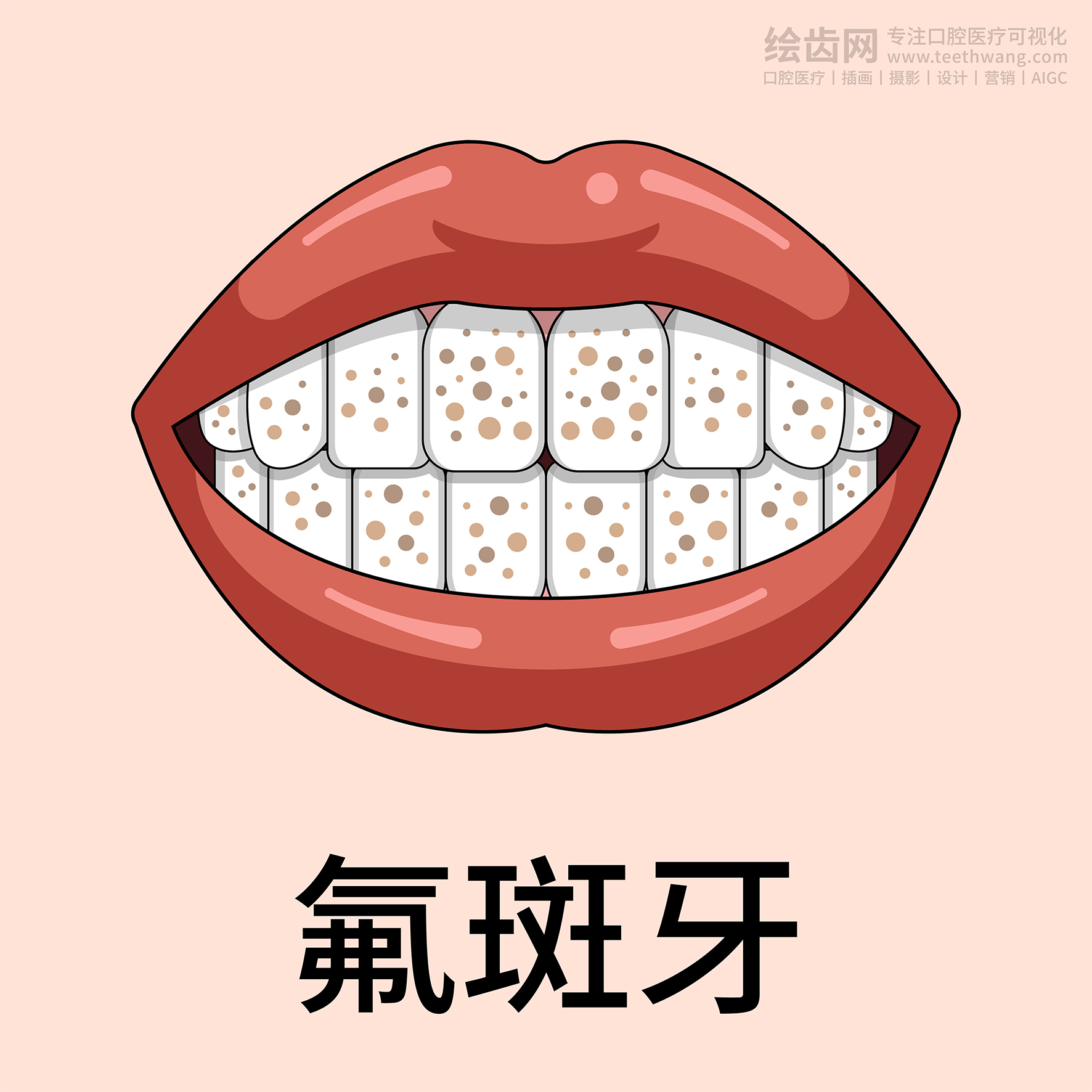 牙齿类型 牙齿贴面