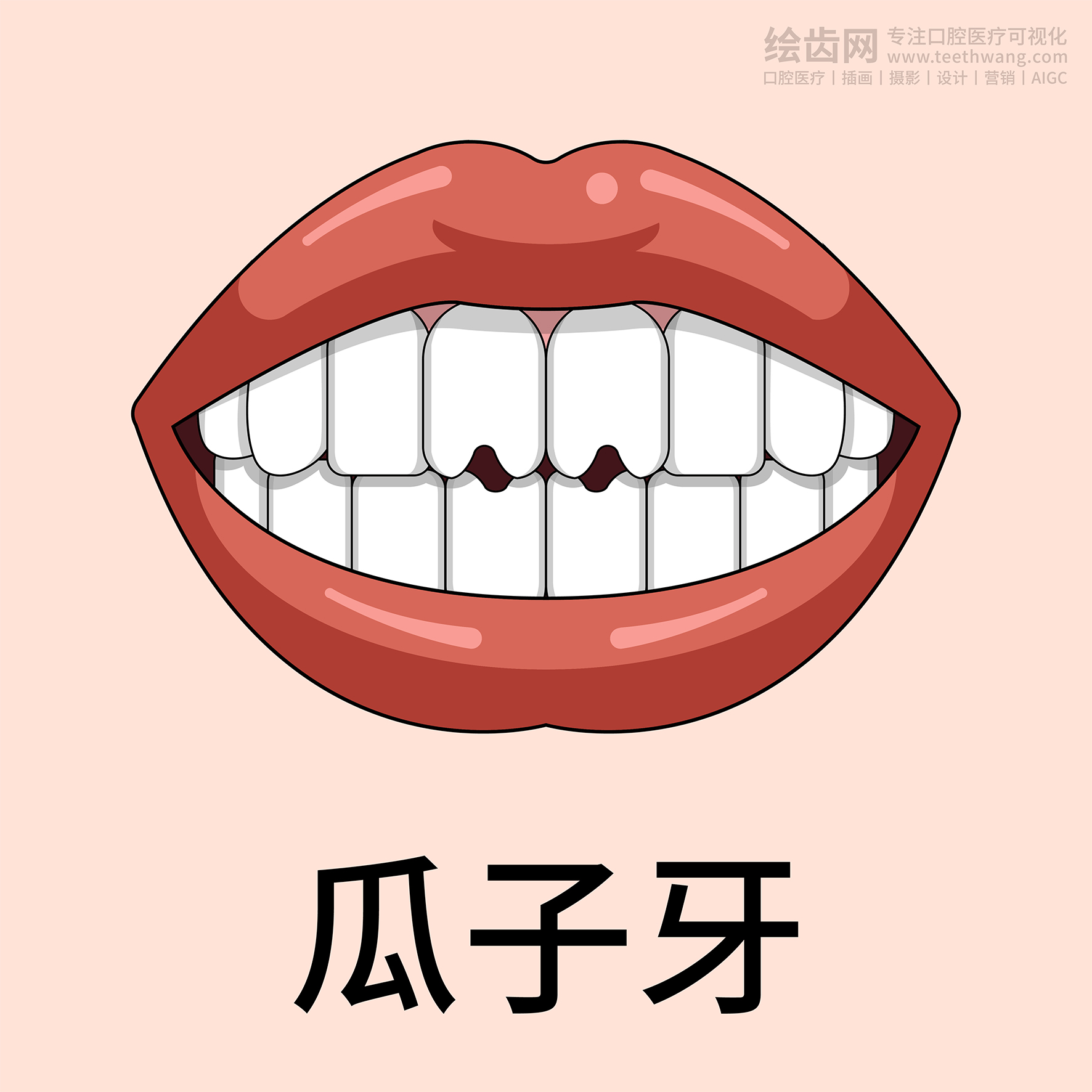 牙齿类型 牙齿贴面