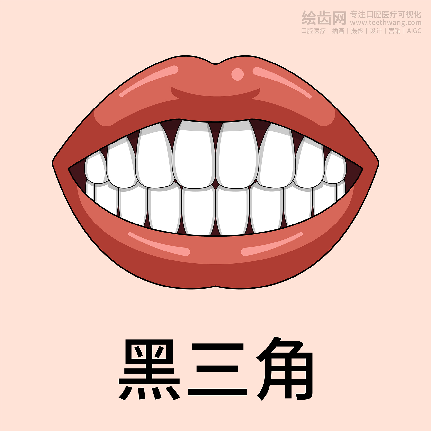 牙齿类型 牙齿贴面