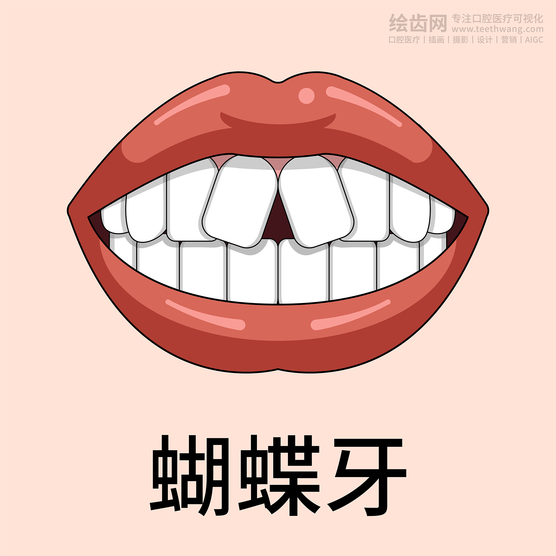 牙齿类型 牙齿贴面