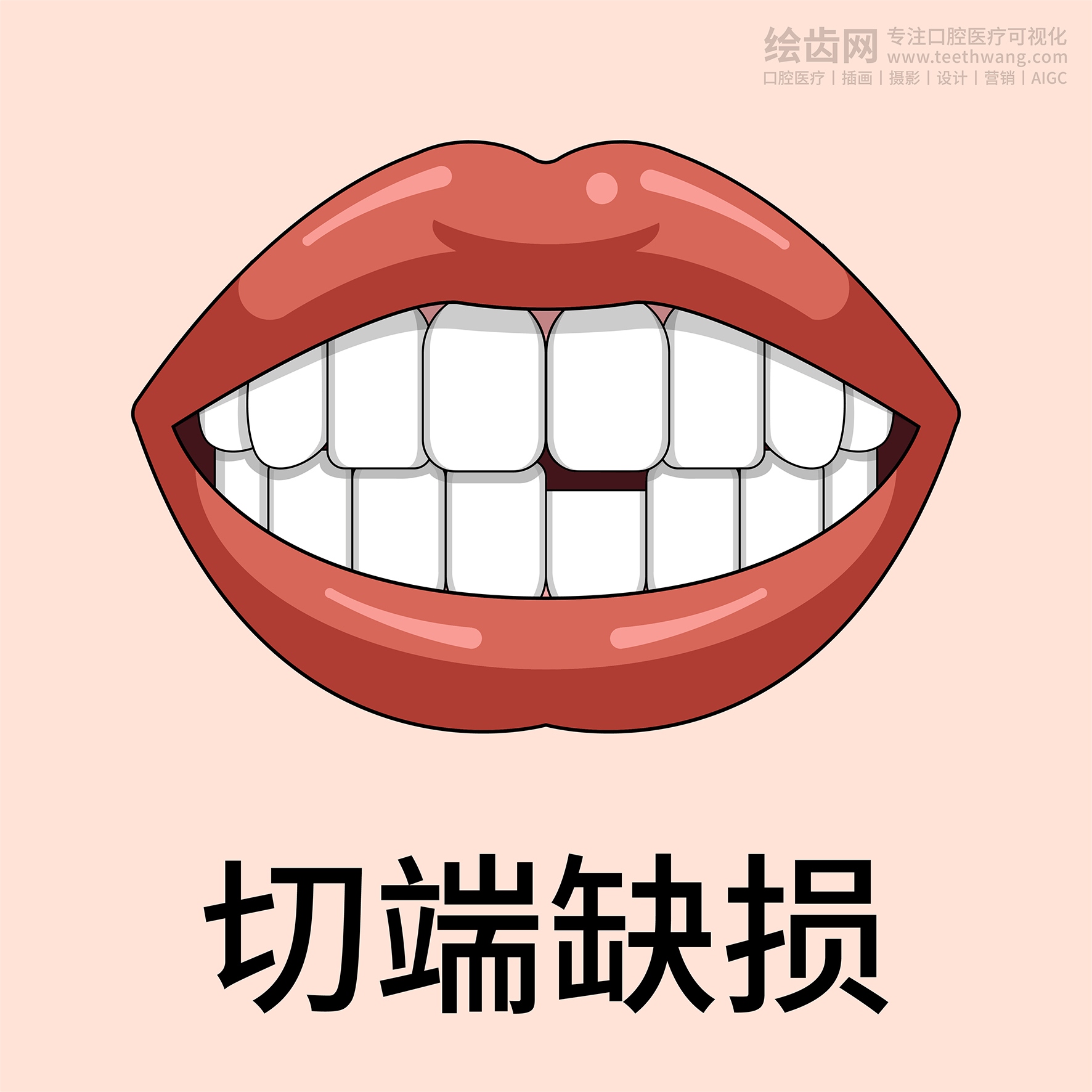 牙齿类型 牙齿贴面