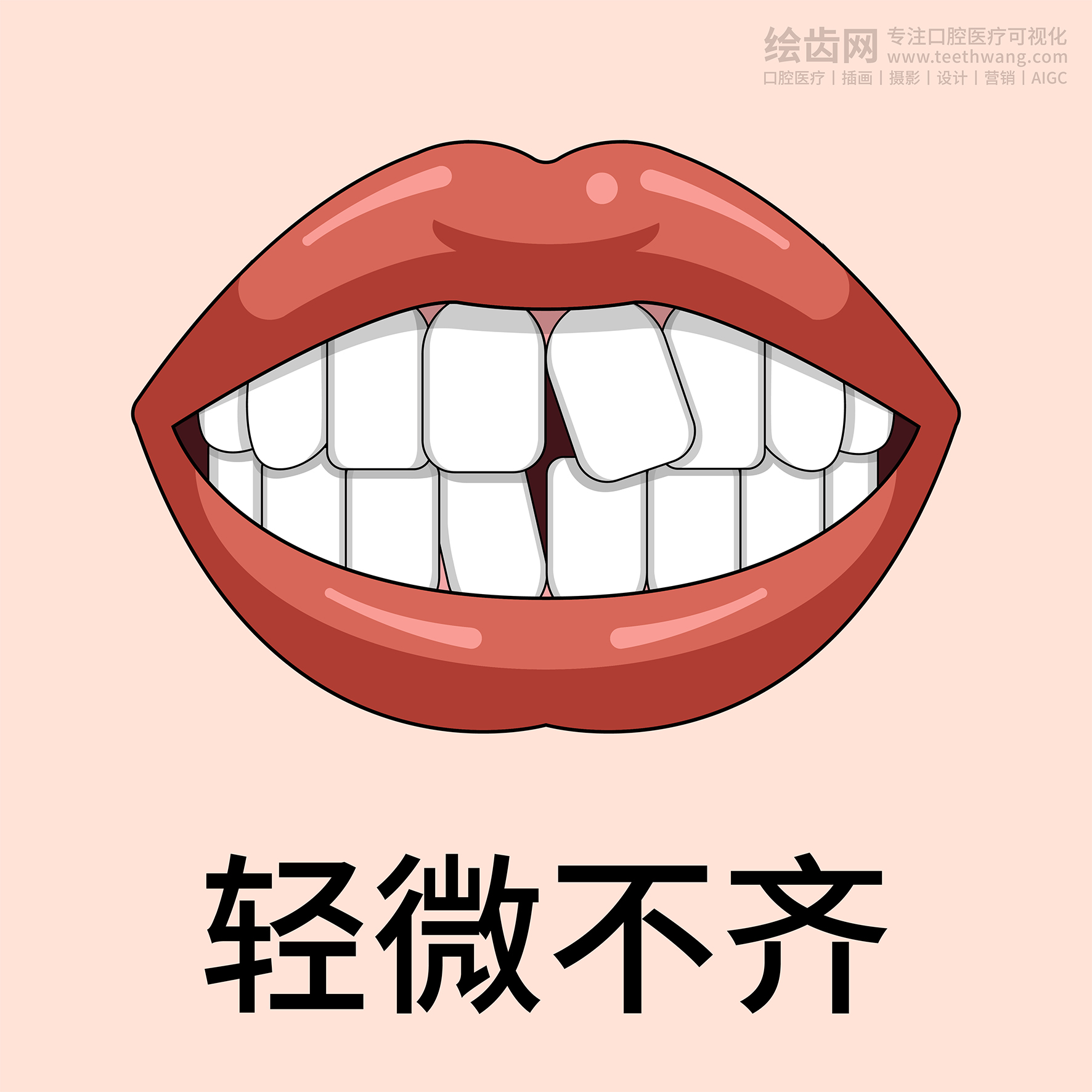 牙齿类型 牙齿贴面