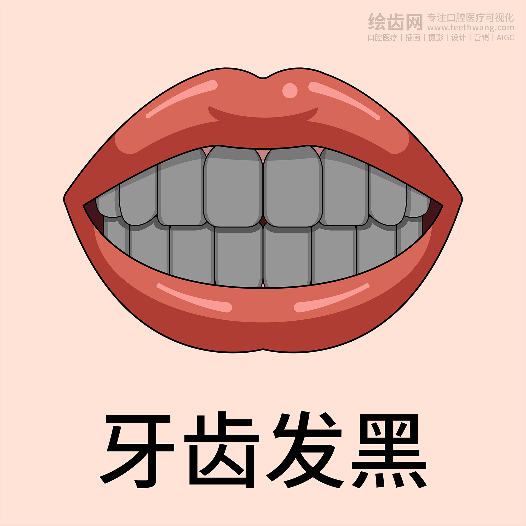 牙齿类型 牙齿贴面