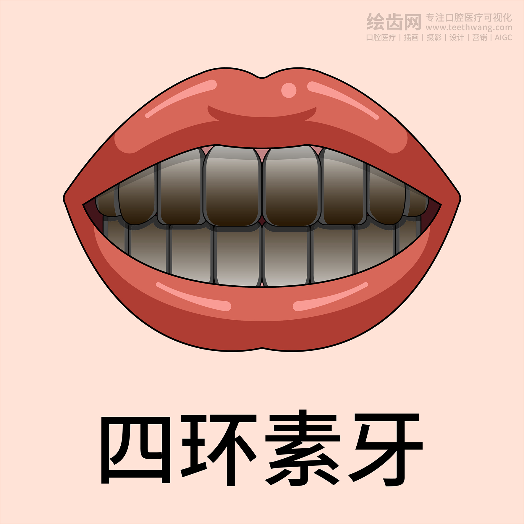 牙齿类型 牙齿贴面