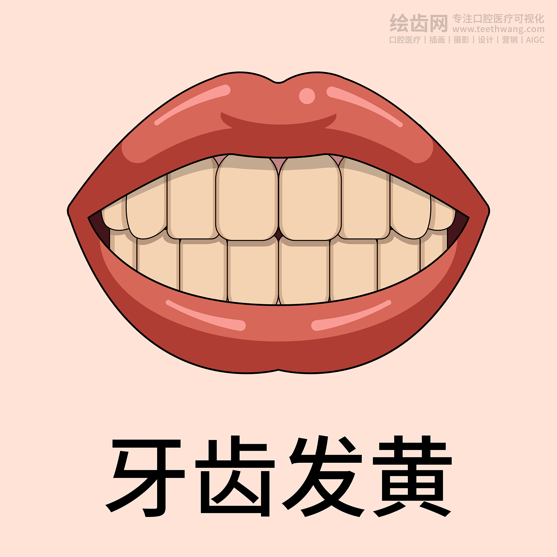 牙齿类型 牙齿贴面