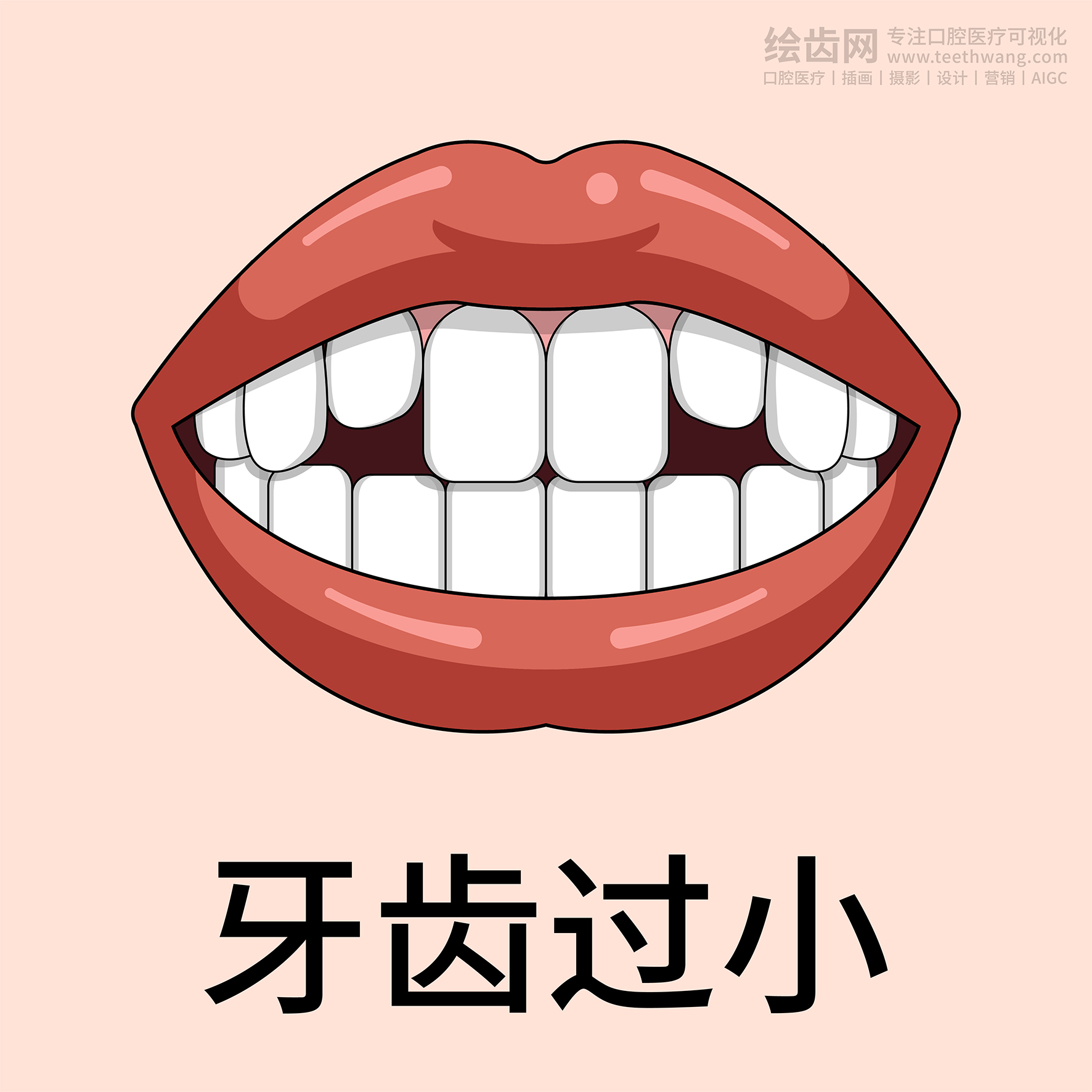 牙齿类型 牙齿贴面