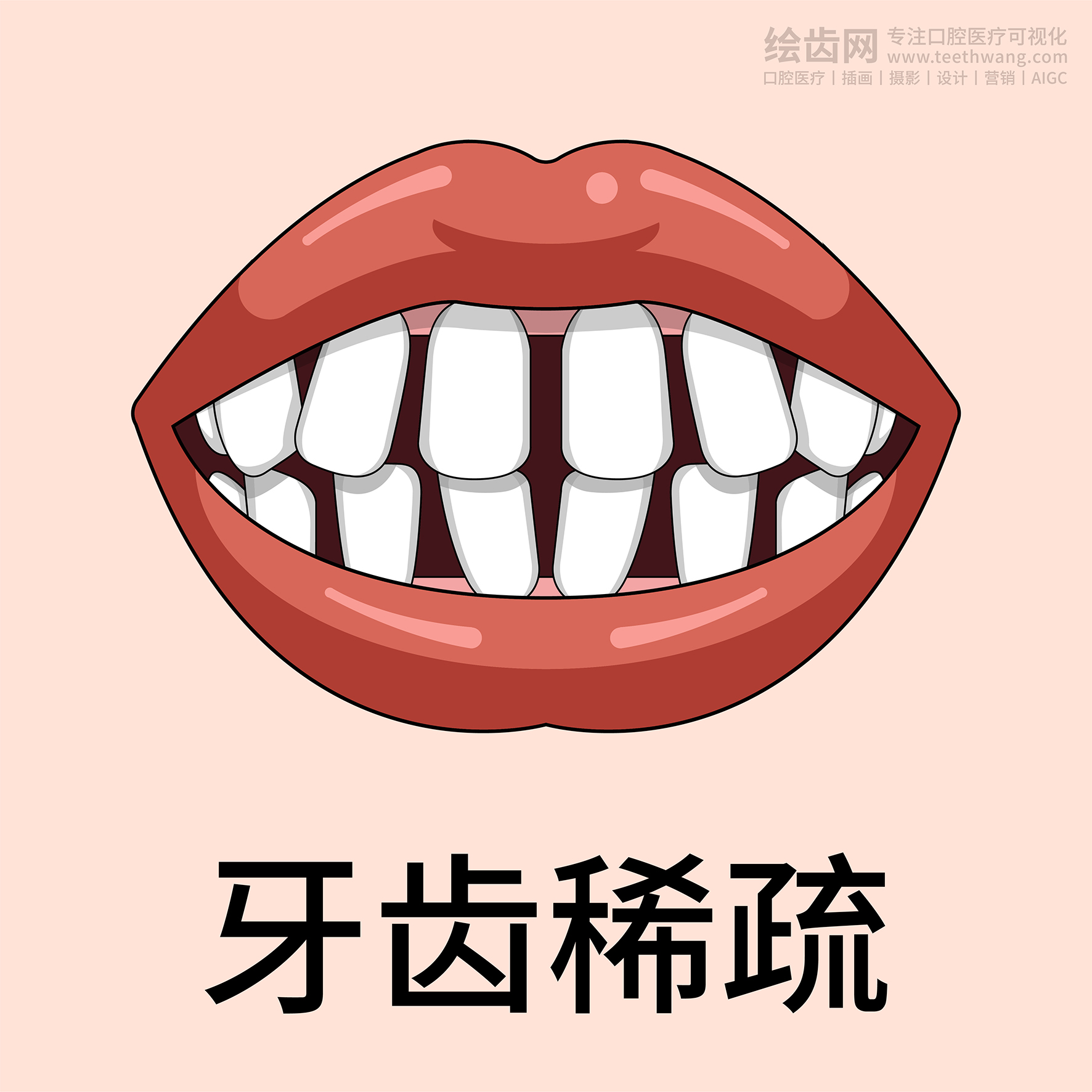 牙齿类型 牙齿贴面