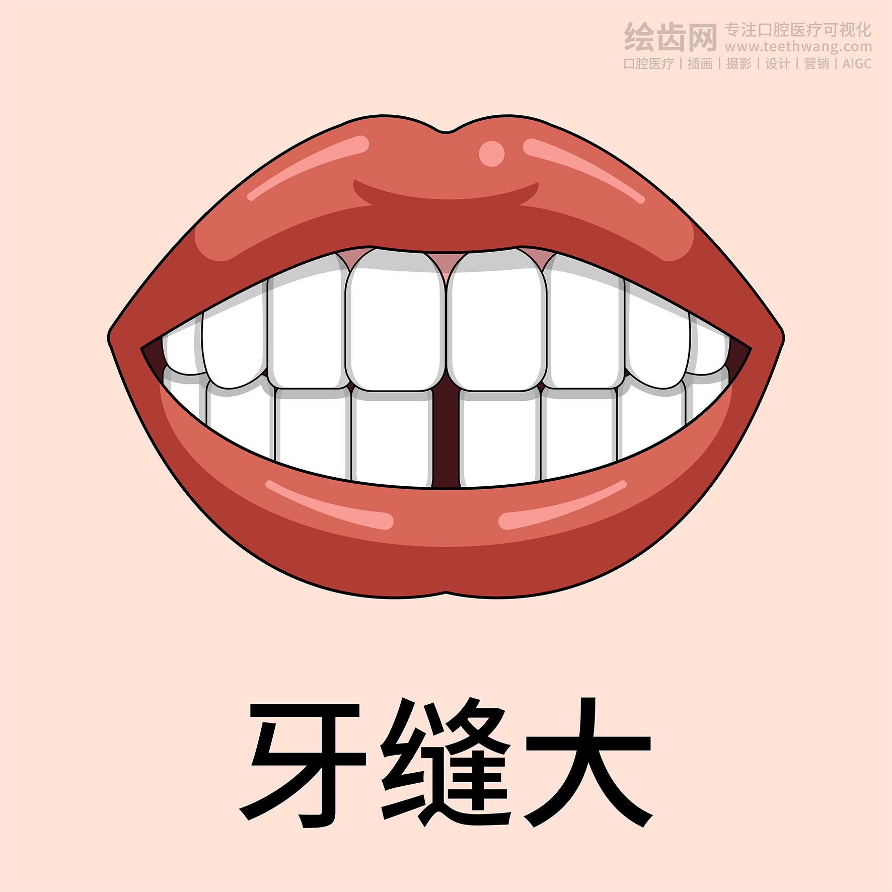 牙齿类型 牙齿贴面