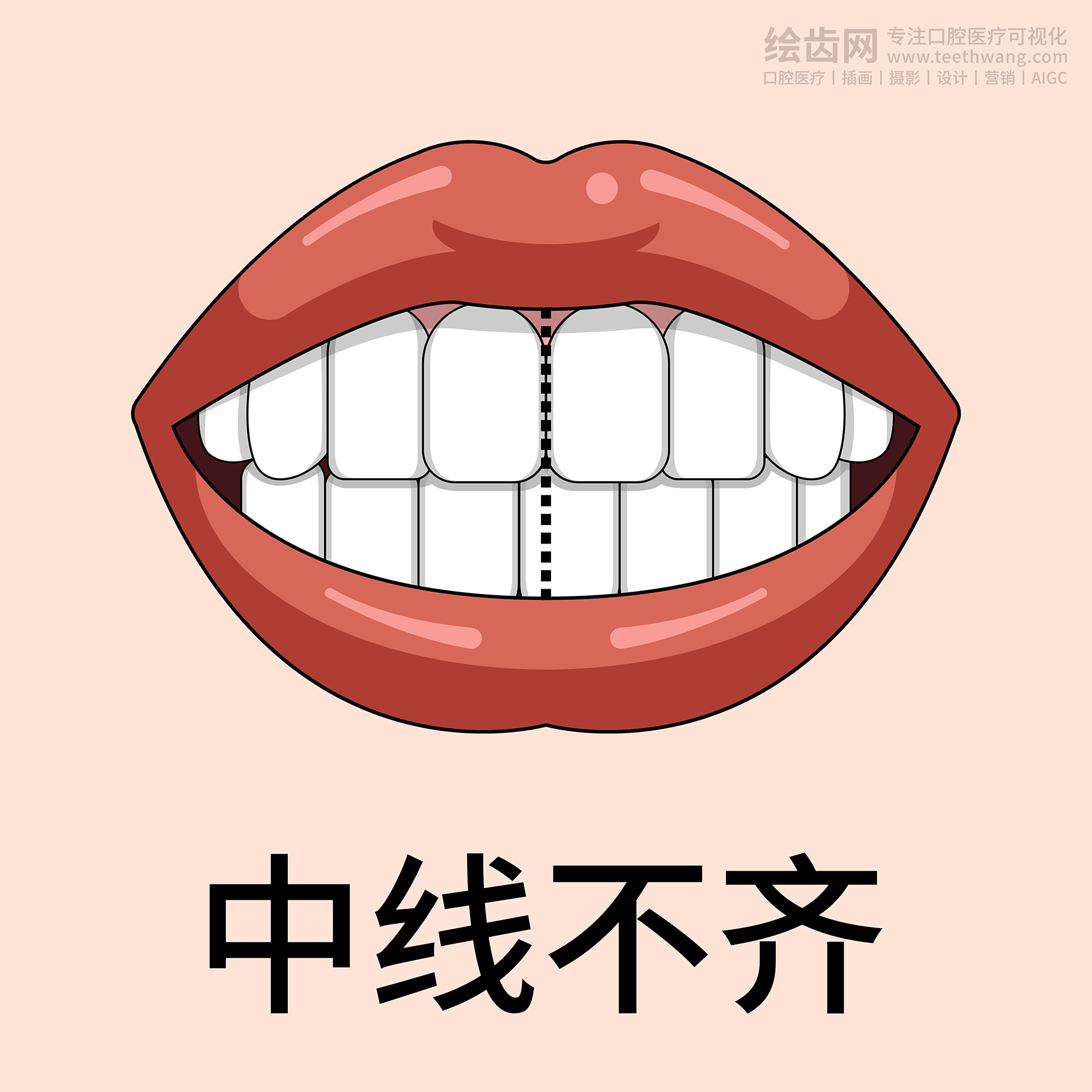 牙齿类型 牙齿贴面