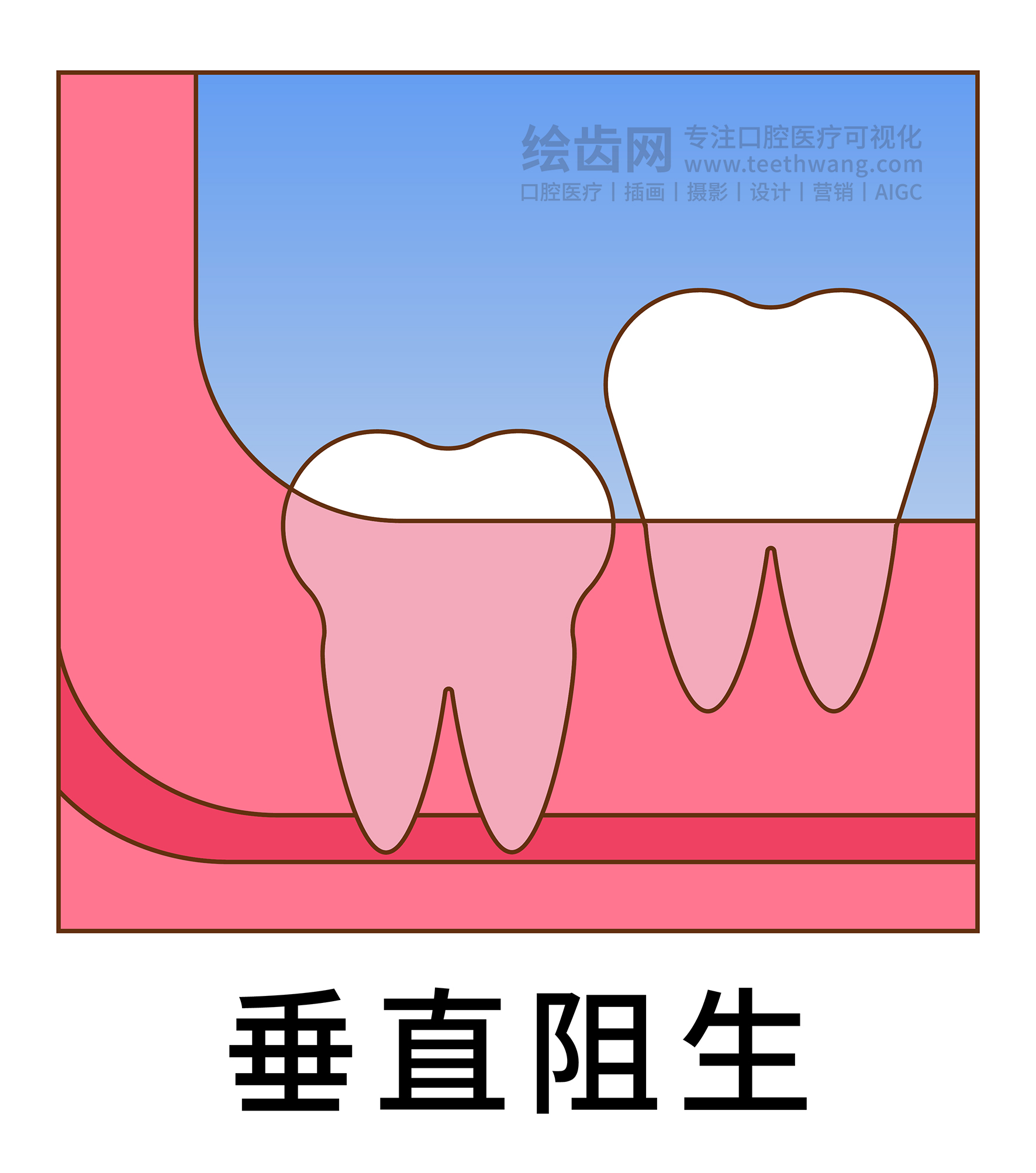 智齿阻生类型图
