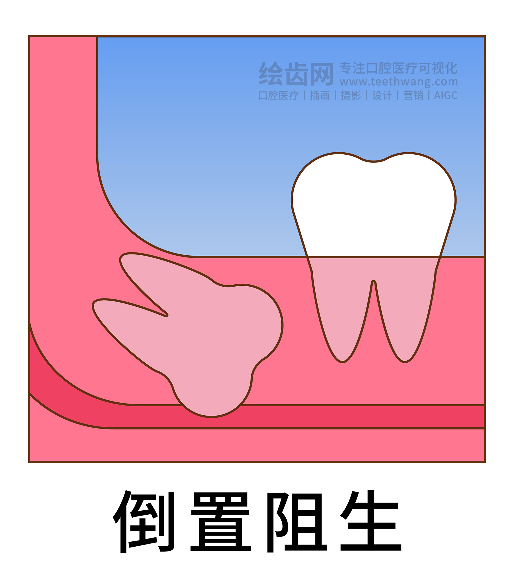 智齿阻生类型图