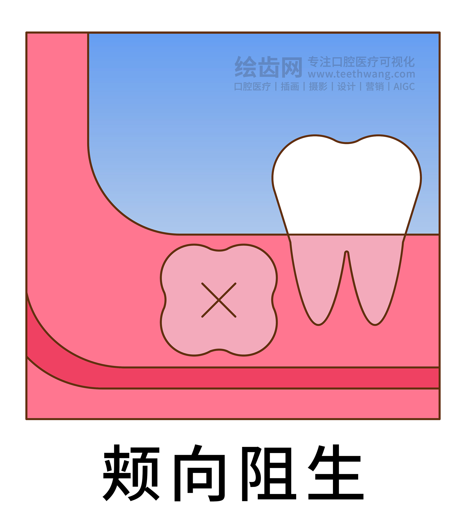智齿阻生类型图