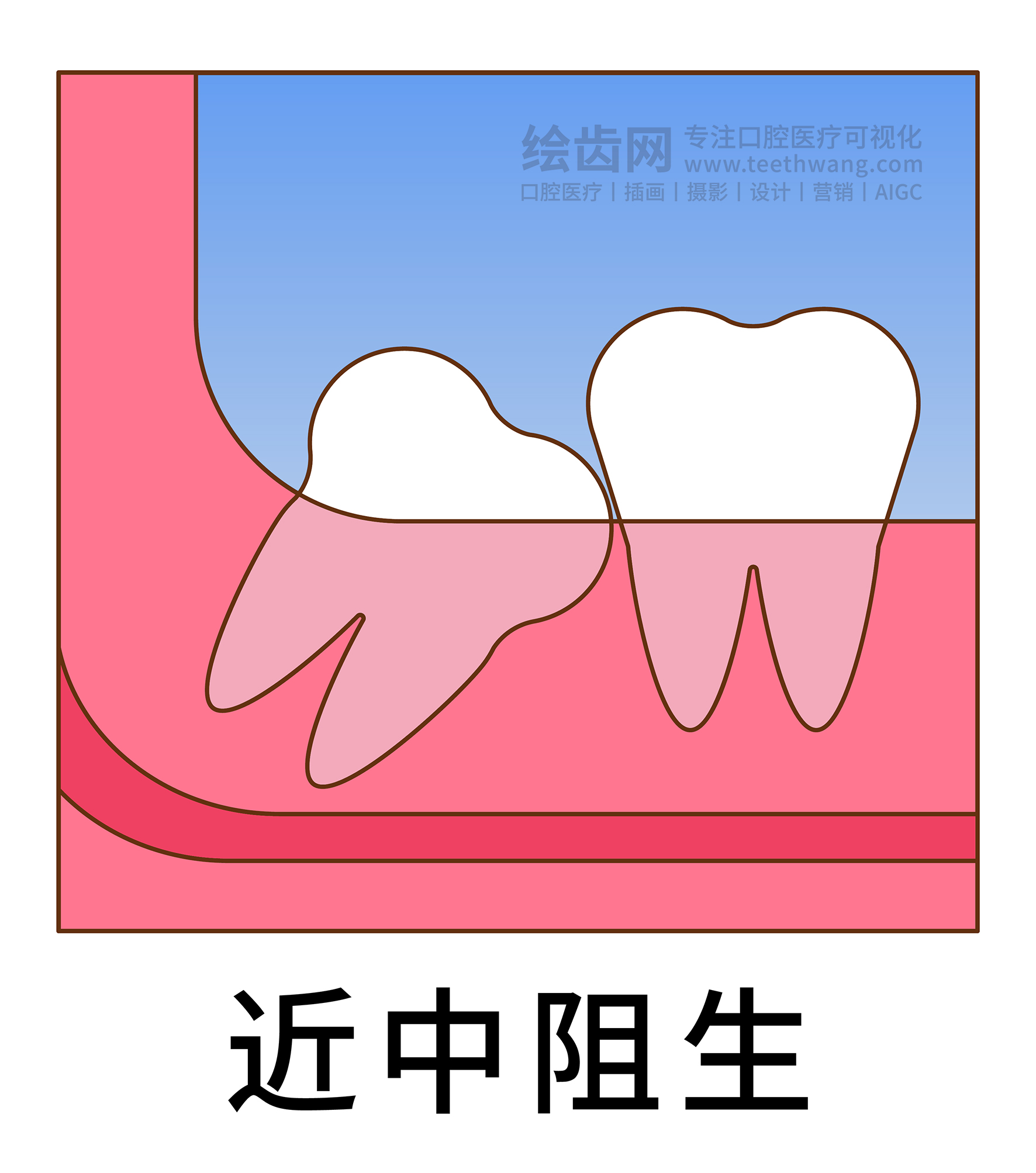 智齿阻生类型图