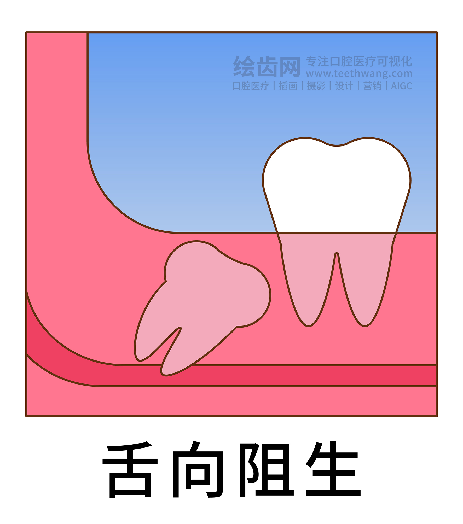智齿阻生类型图