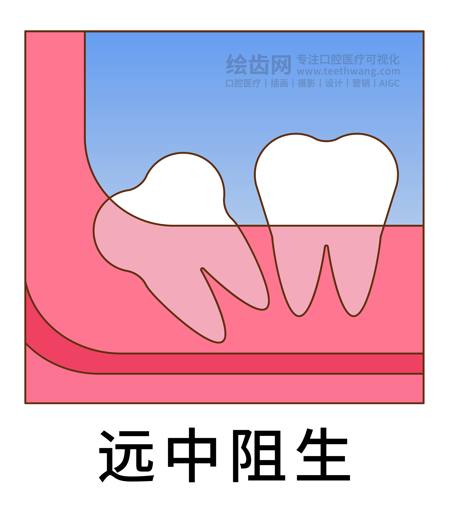 智齿阻生类型图