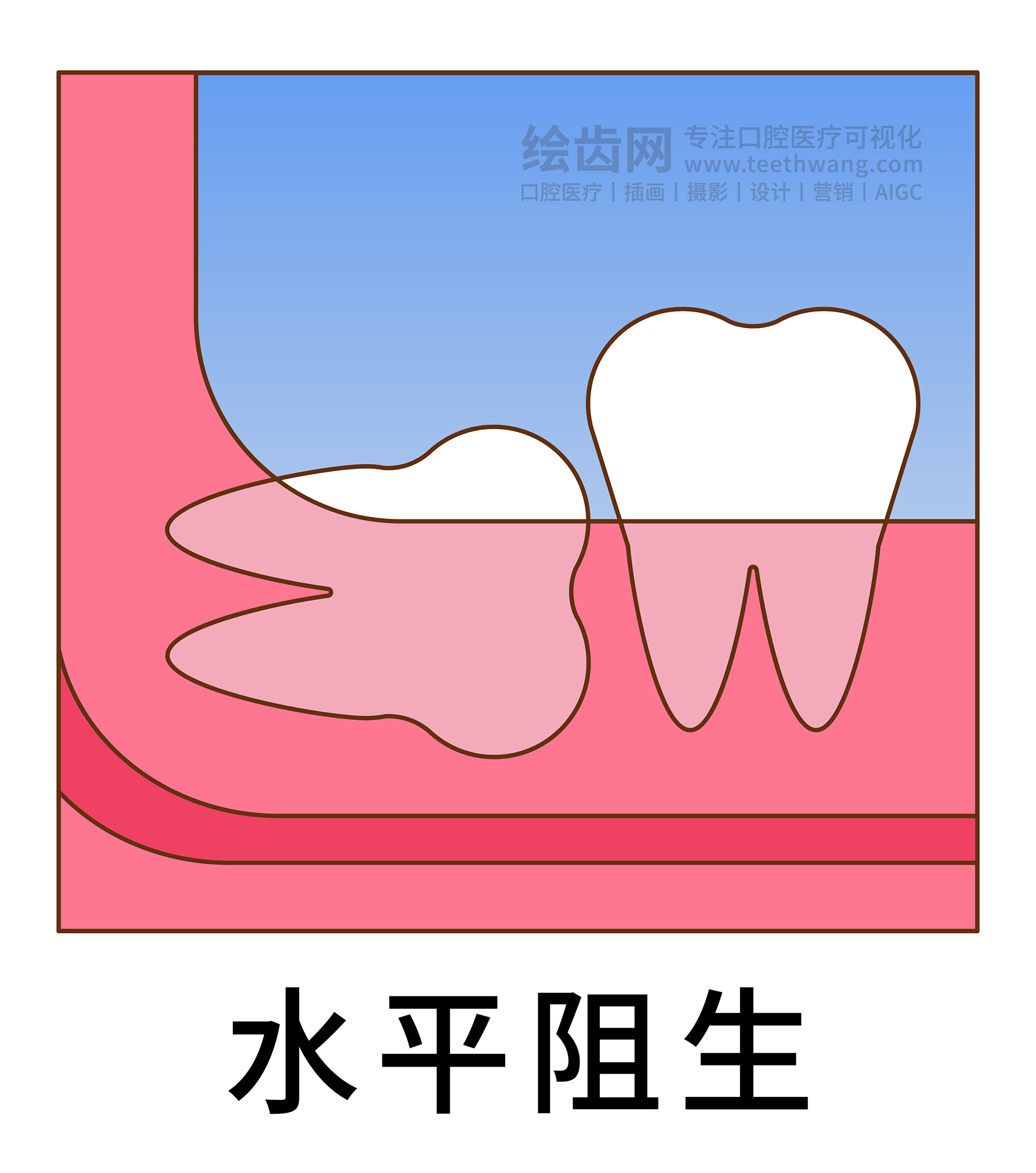 智齿阻生类型图