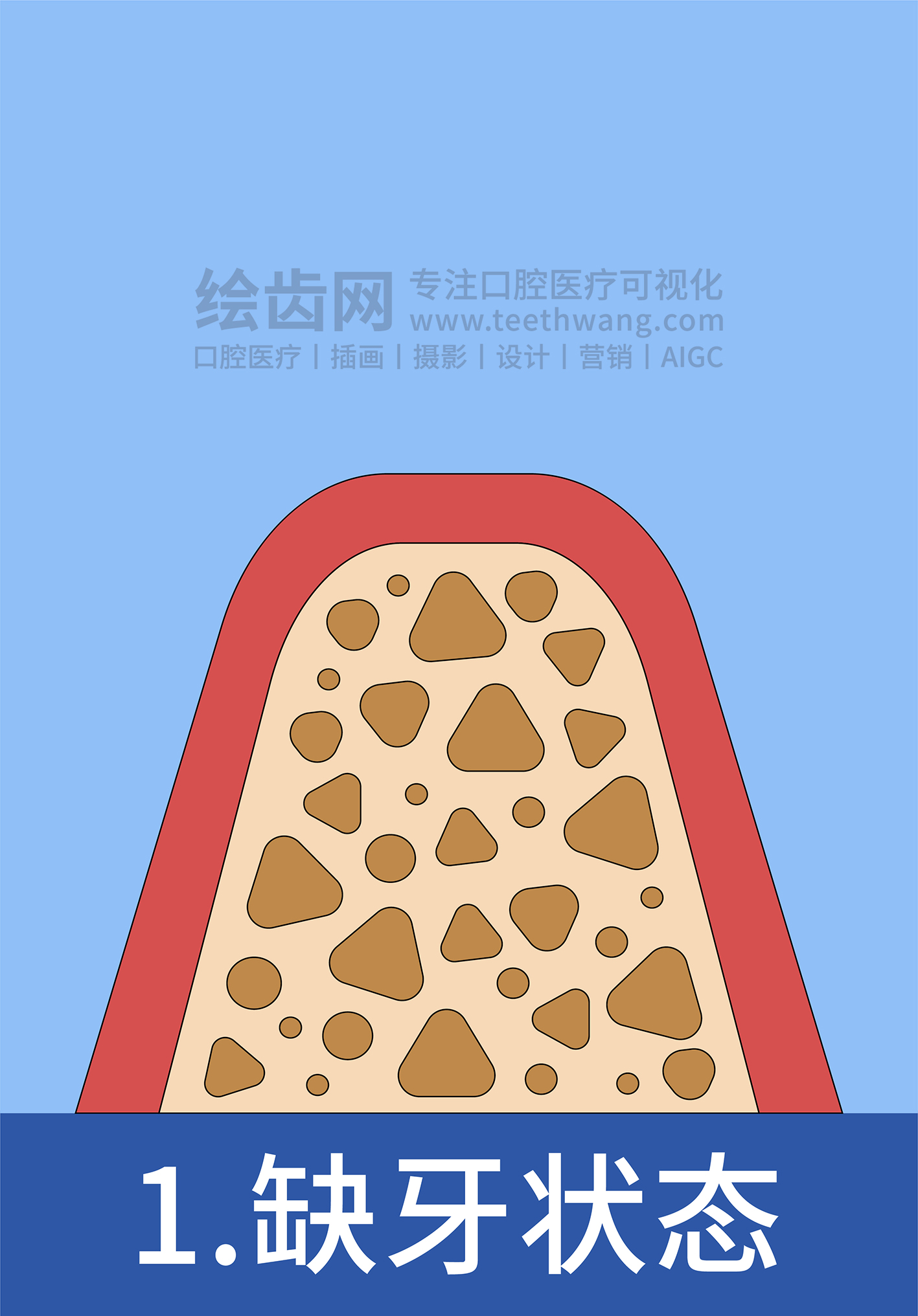 牙齿插画 种牙 种植牙四部曲（蓝色背景）