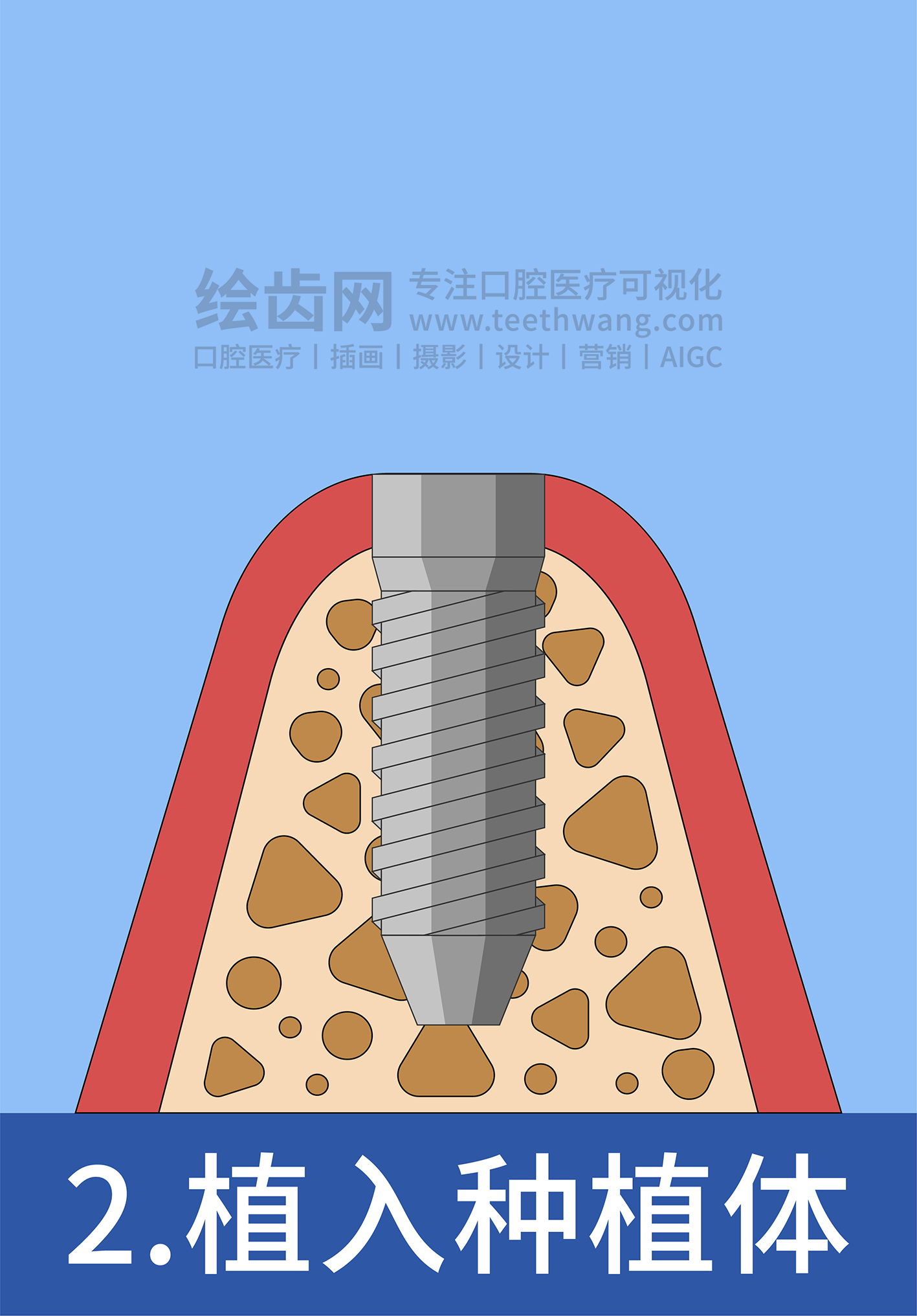 牙齿插画 种牙 种植牙四部曲（蓝色背景）