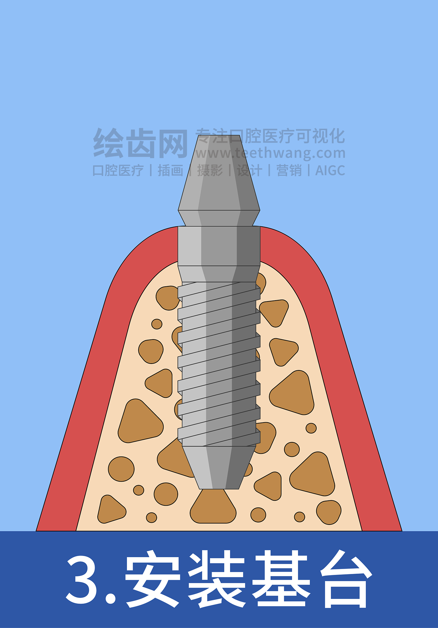 牙齿插画 种牙 种植牙四部曲（蓝色背景）