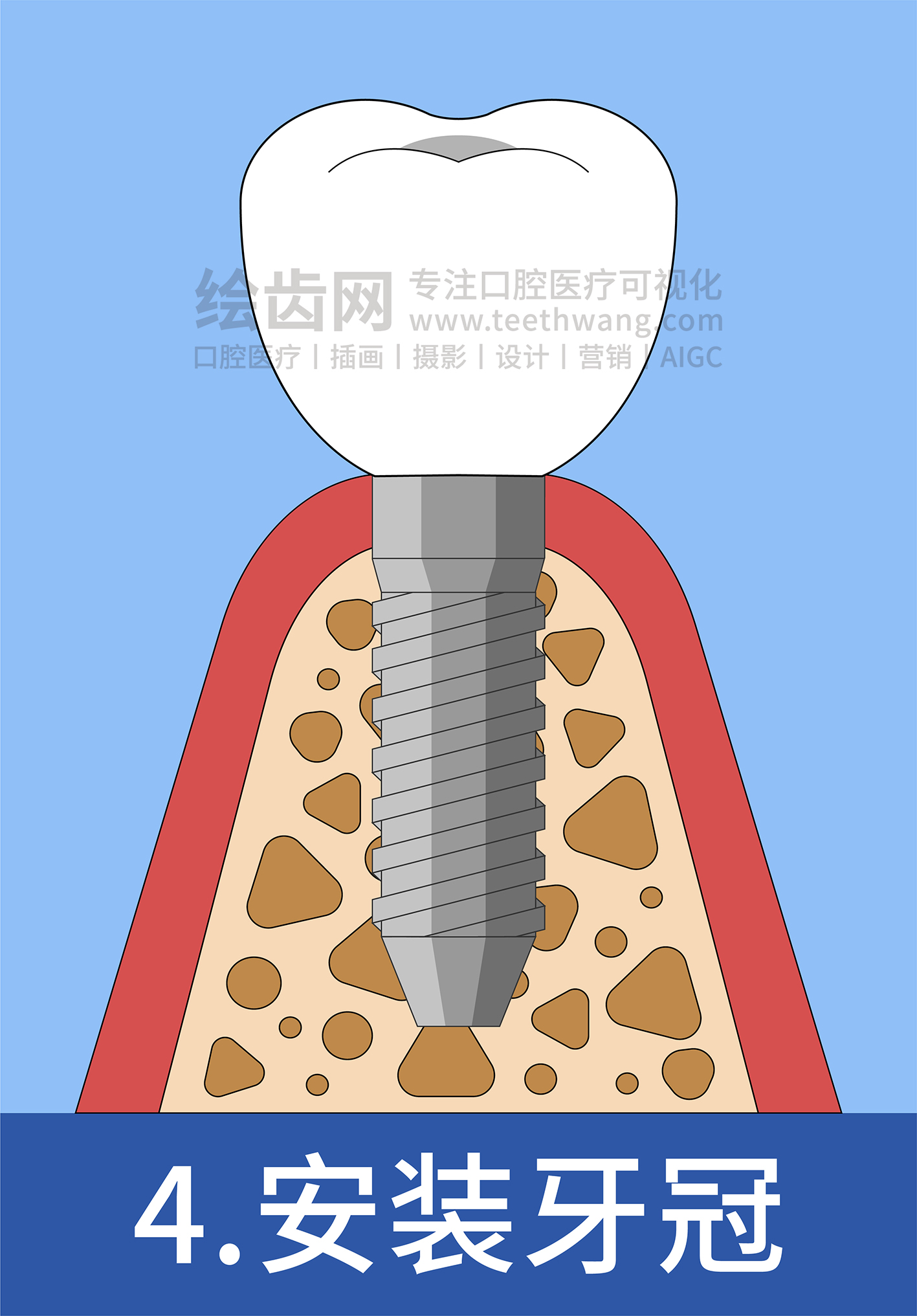牙齿插画 种牙 种植牙四部曲（蓝色背景）