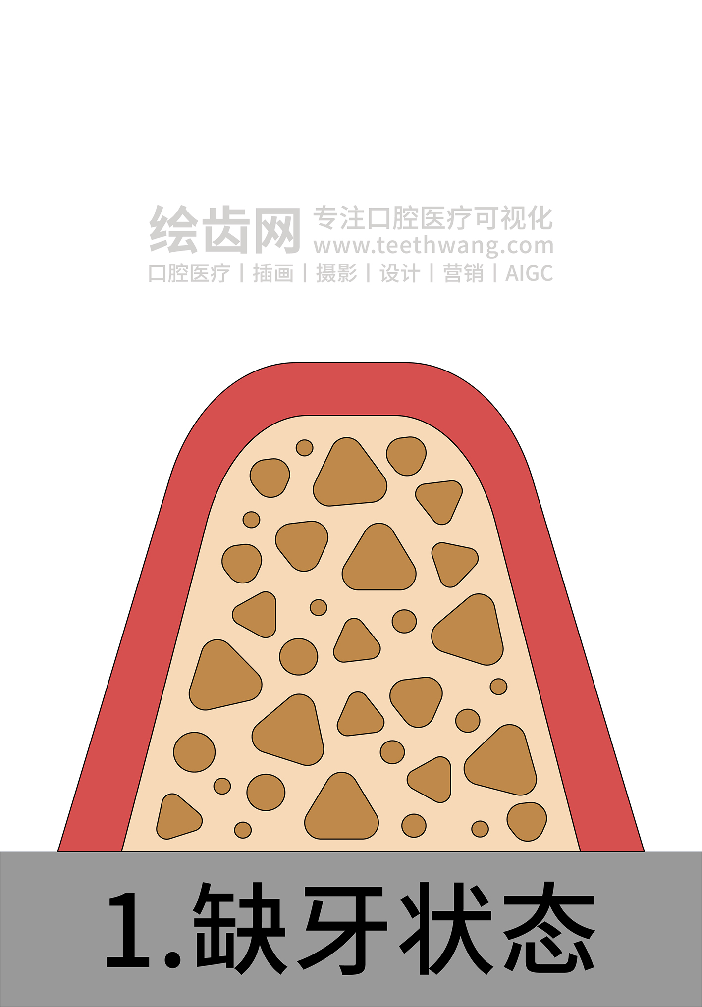 牙齿插画 种牙 种植牙四部曲（白色背景）