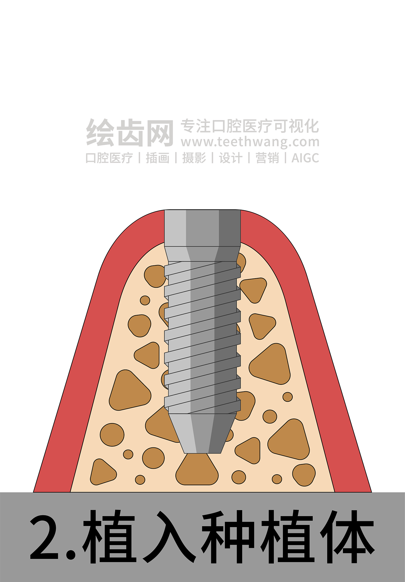 牙齿插画 种牙 种植牙四部曲（白色背景）