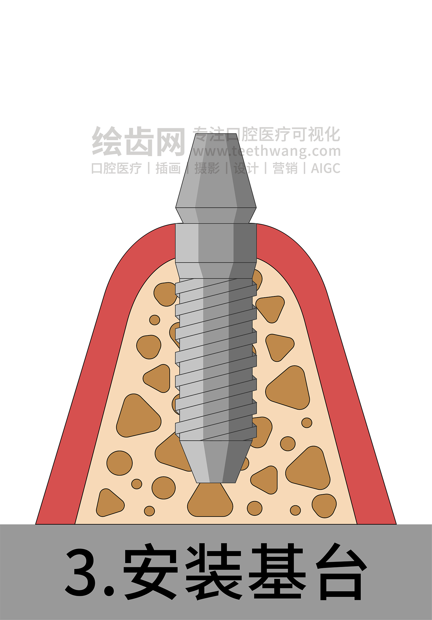牙齿插画 种牙 种植牙四部曲（白色背景）