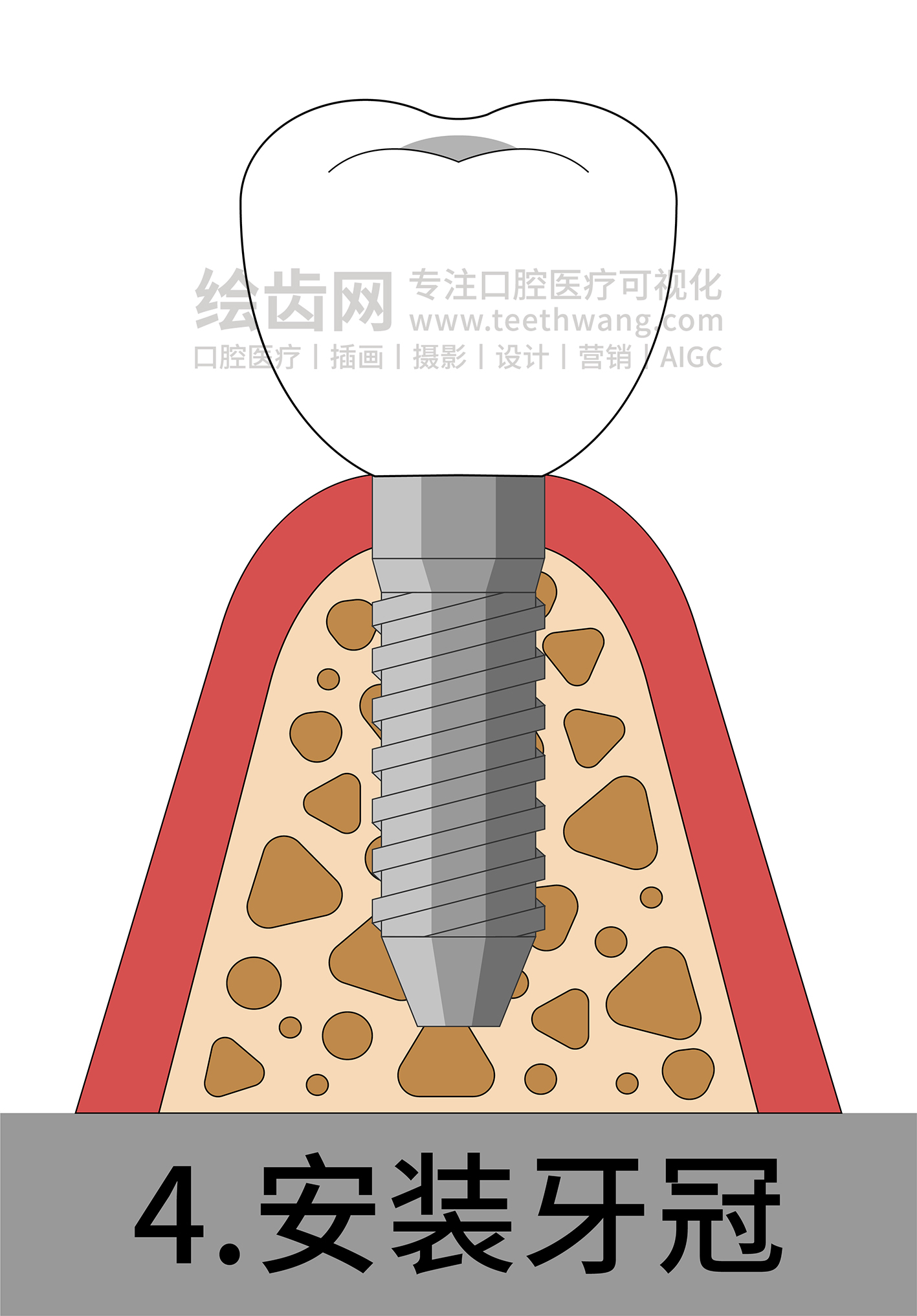 牙齿插画 种牙 种植牙四部曲（白色背景）