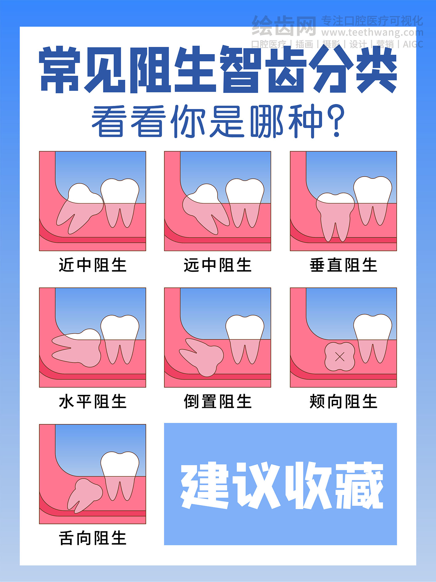 常见阻生智齿分类