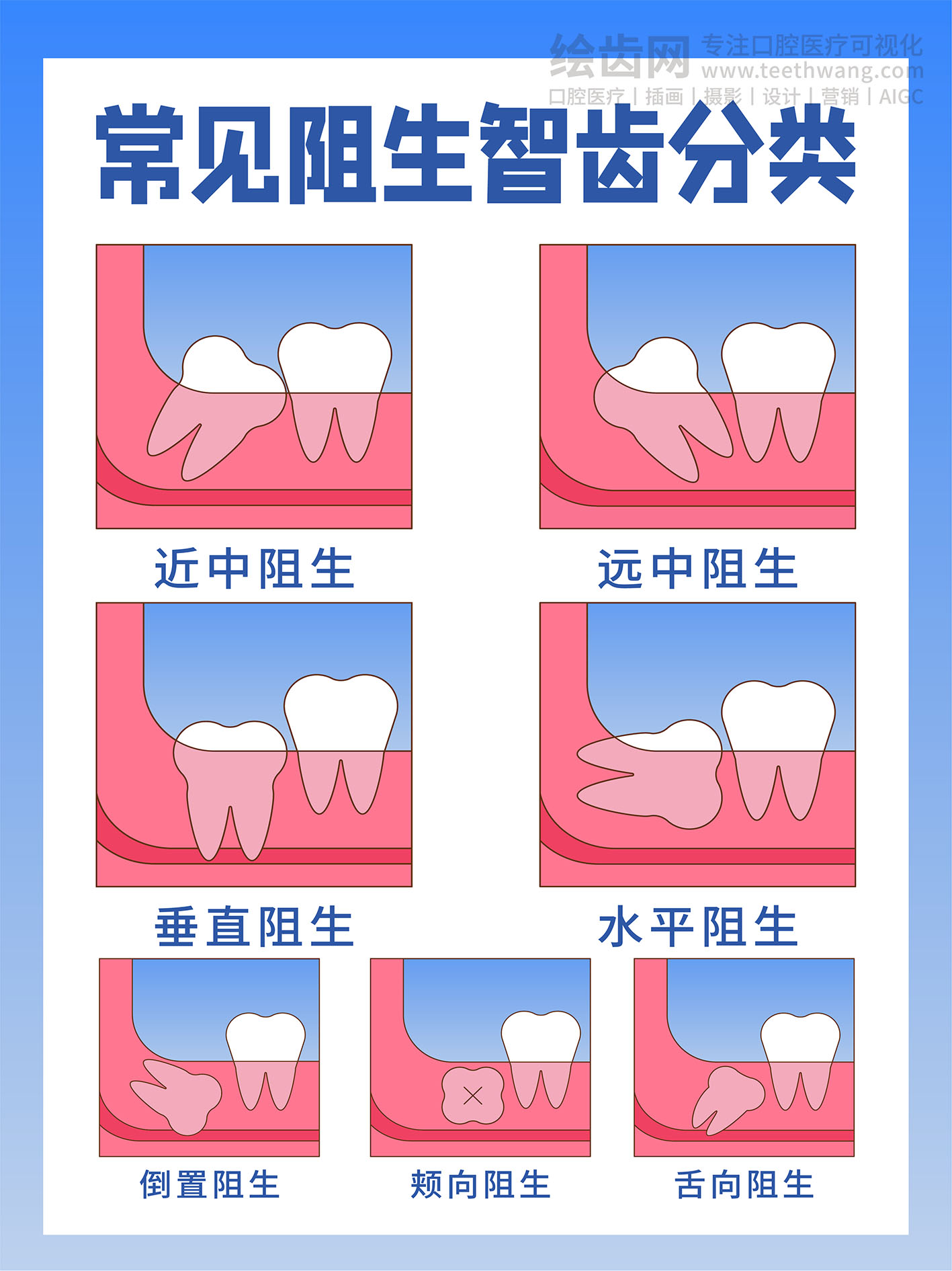 常见阻生智齿分类