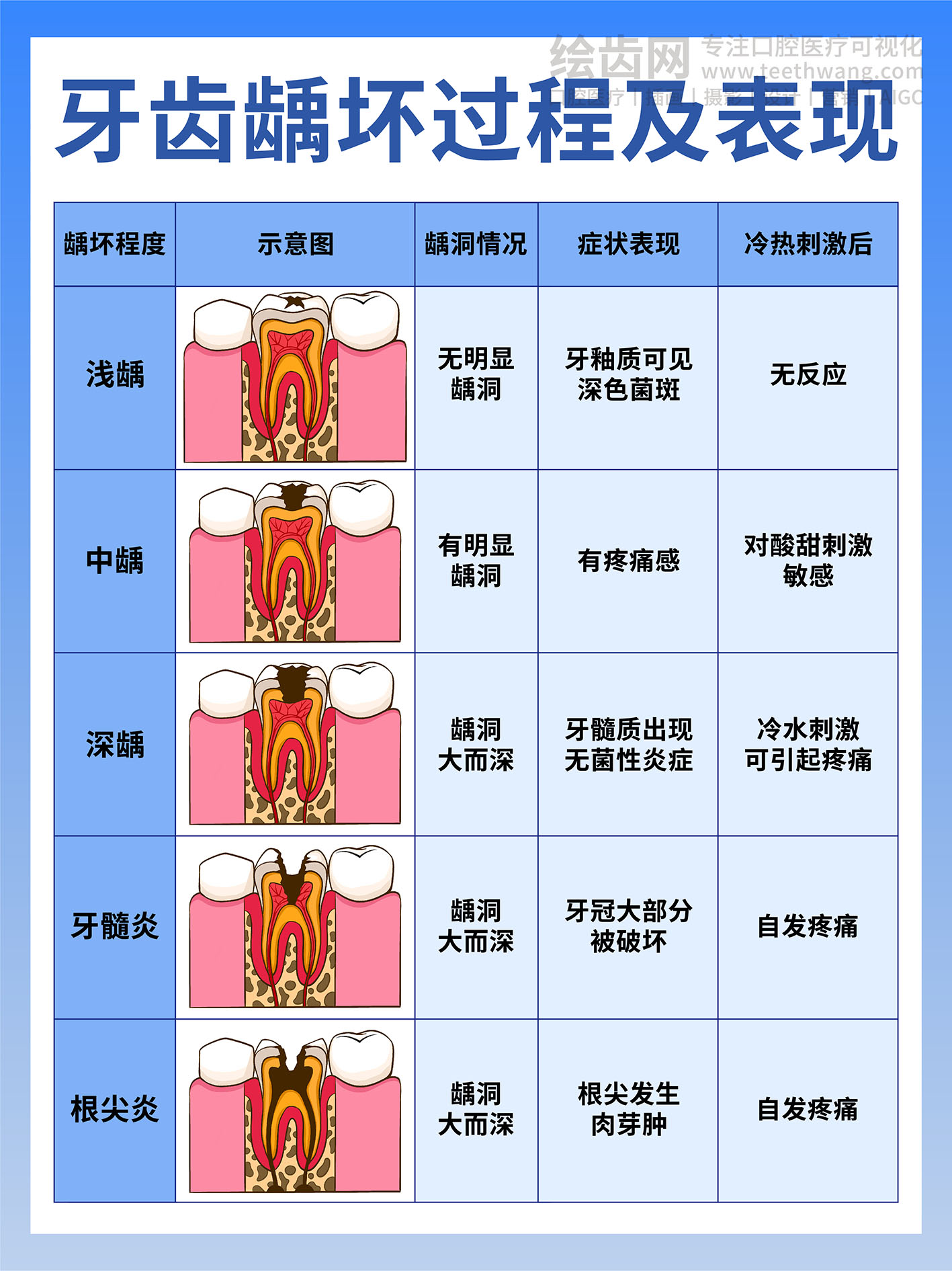 牙齿龋坏过程及表现