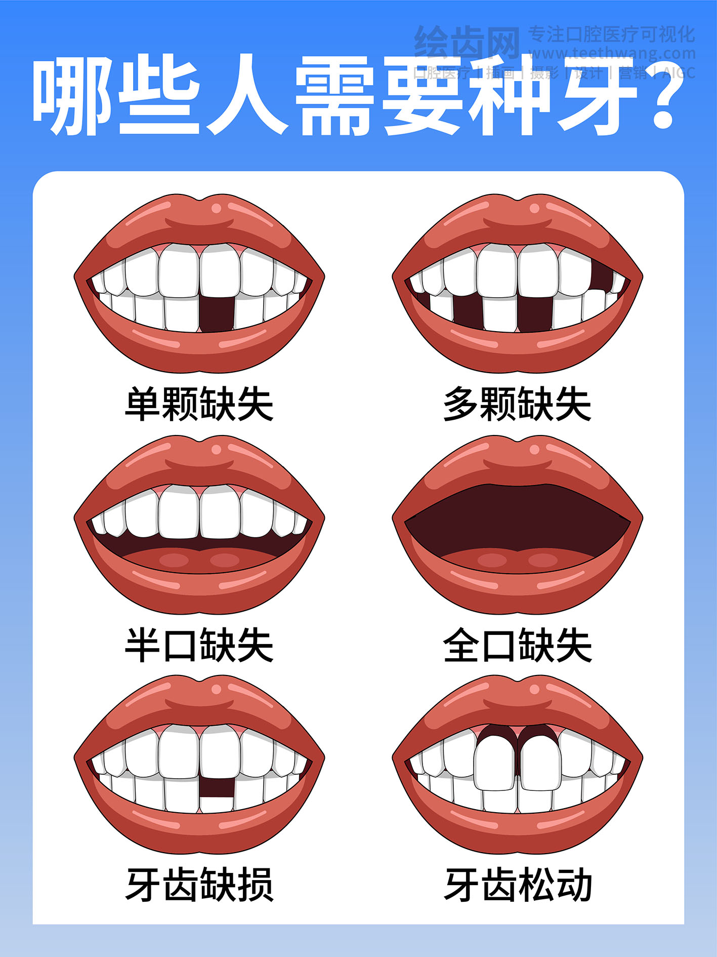 哪些人需要种牙？