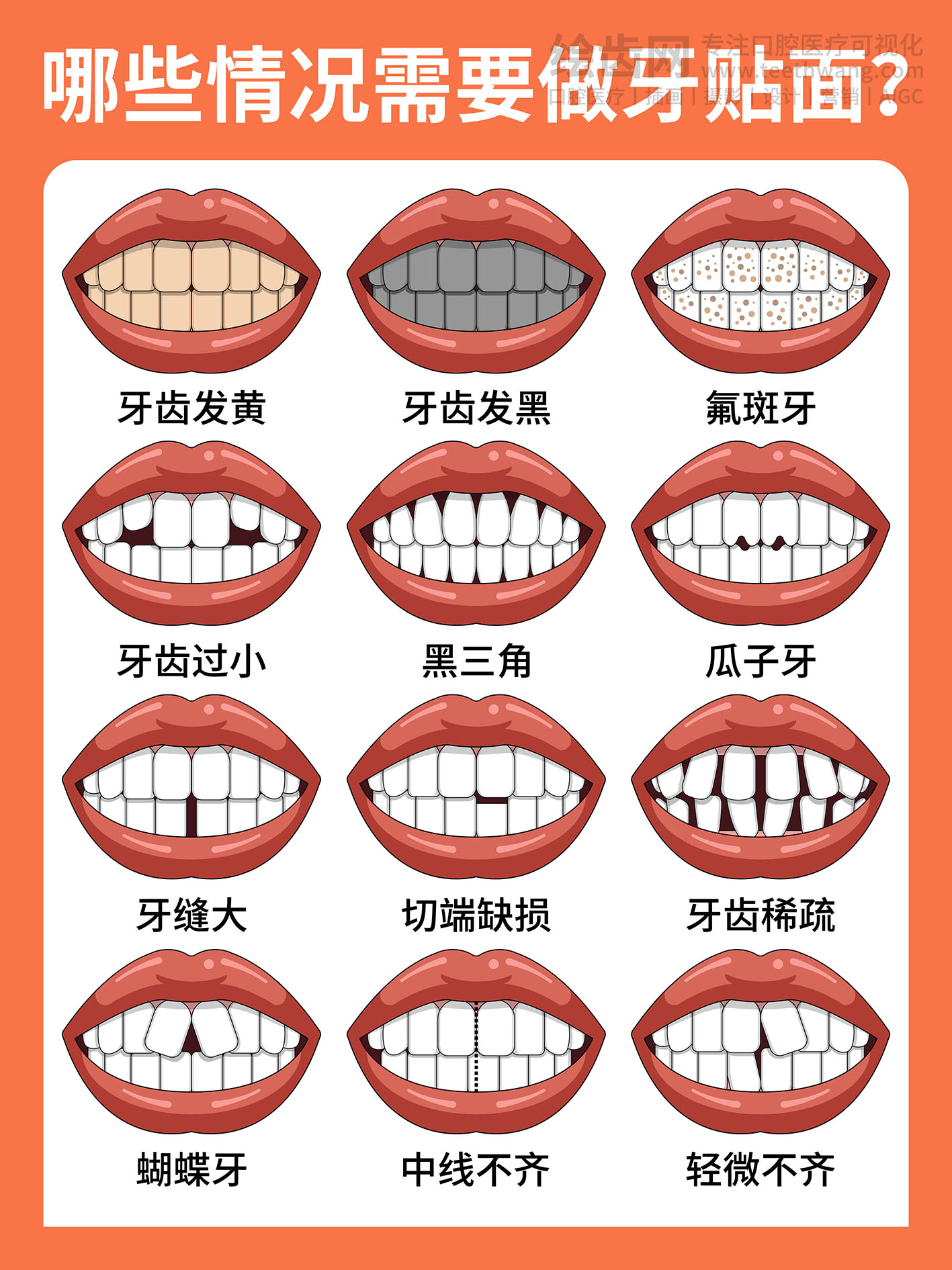 哪些情况需要做牙贴面