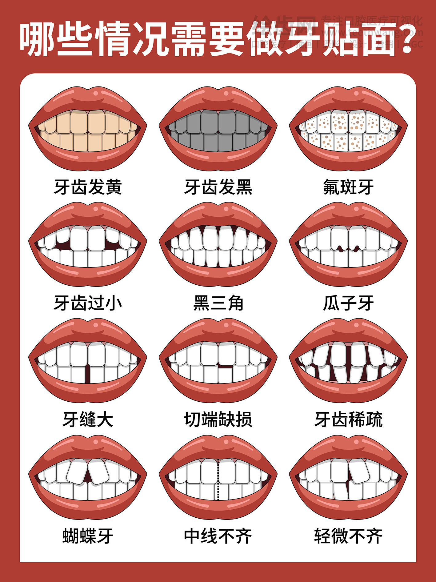 哪些情况需要做牙贴面