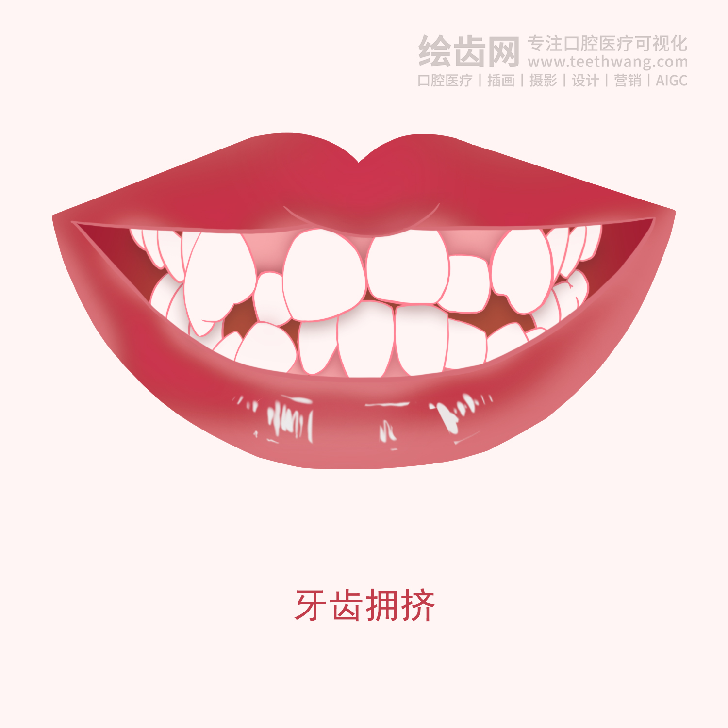 常见牙齿矫正类型有哪些？