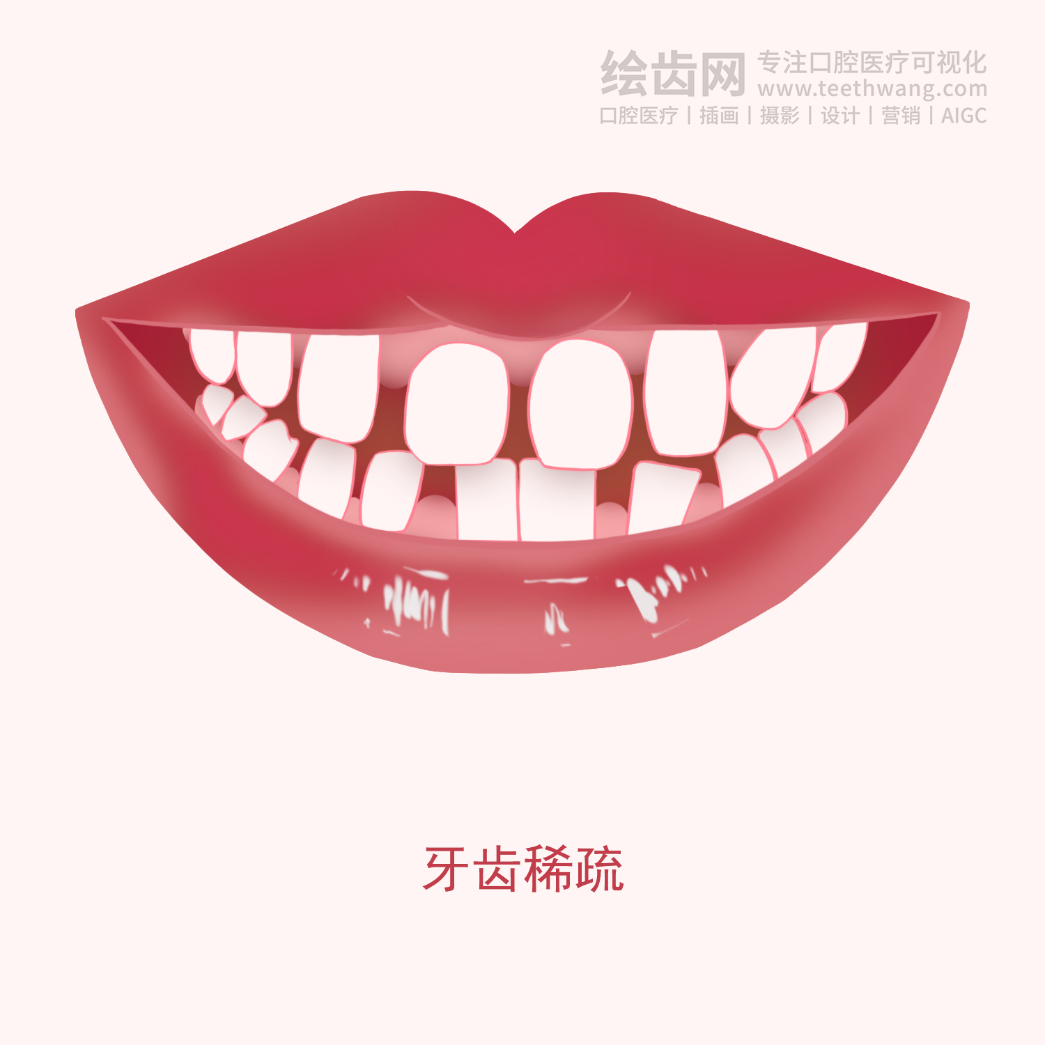 常见牙齿矫正类型有哪些？